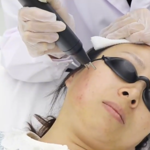 Face & Neck - Nitrogen Plasma Skin Regeneration