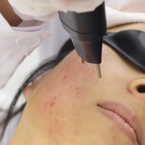 Full Face - Nitrogen Plasma Skin Rejuvenation