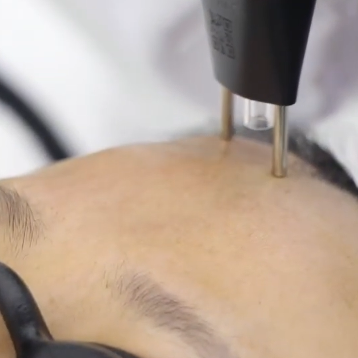 Face & Neck - Nitrogen Plasma Skin Regeneration